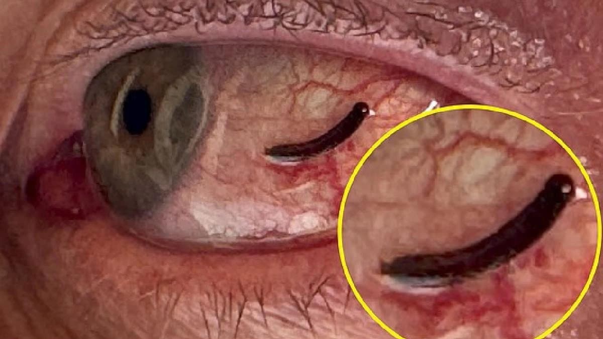 British Traveller had a leech on his eyeball