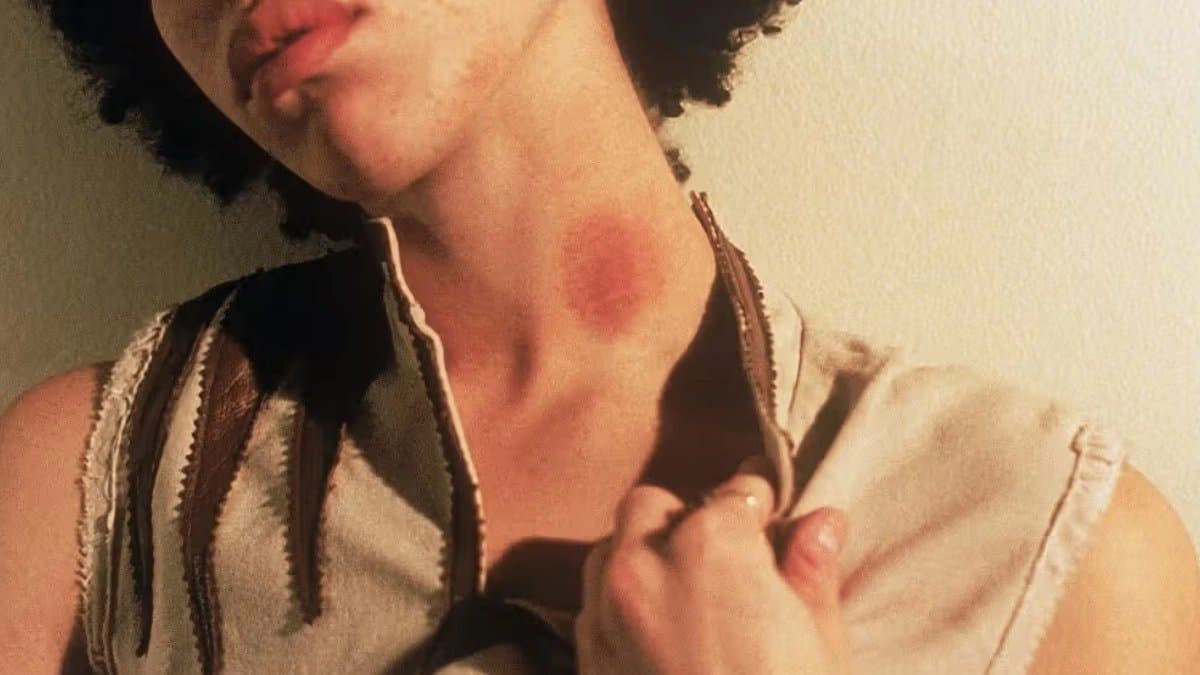 love bite Side Effects: hickey can be harmful to your health even it can take away breath