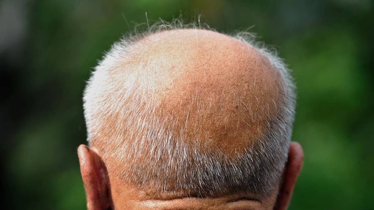 Beetroot and amla juice home remedy for Hair loss and Gray Hair