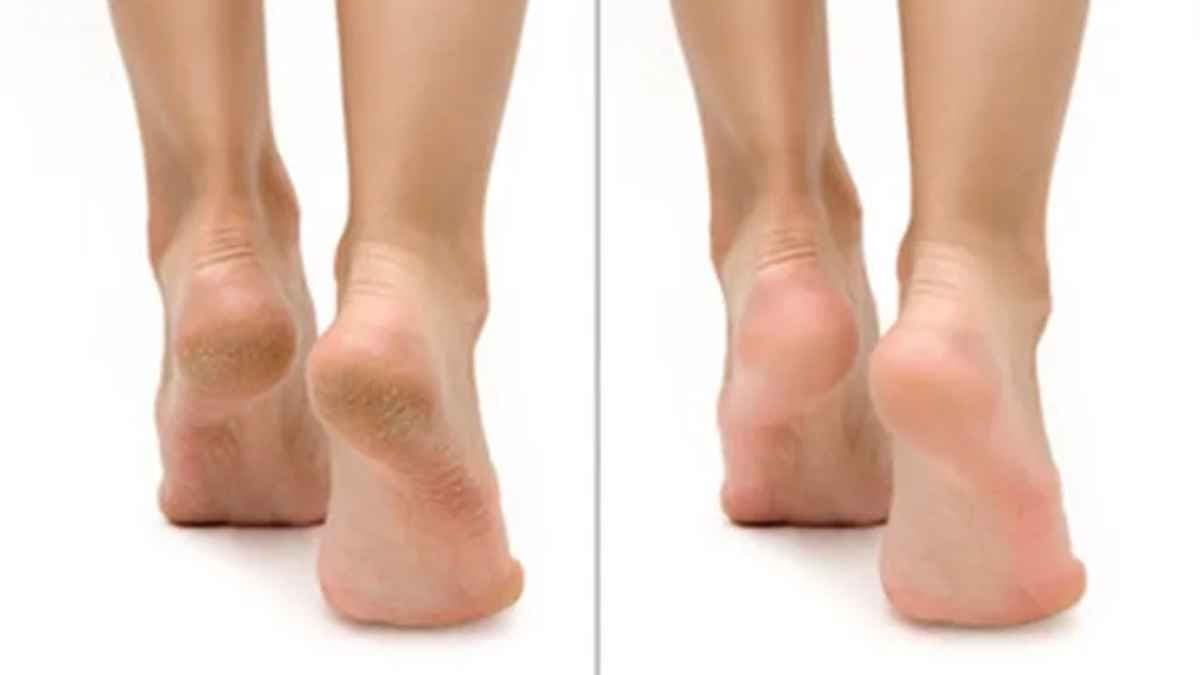 This home made cream for cracked heels can make your feet and heel soft and beautiful lif