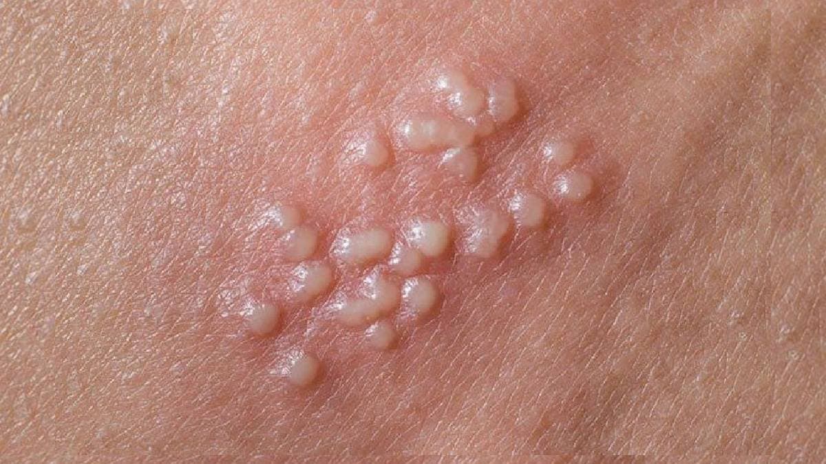 Blisters and flu among the main symptoms of Herpes