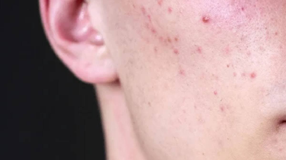  Quits Job Over One Pimple viral post 