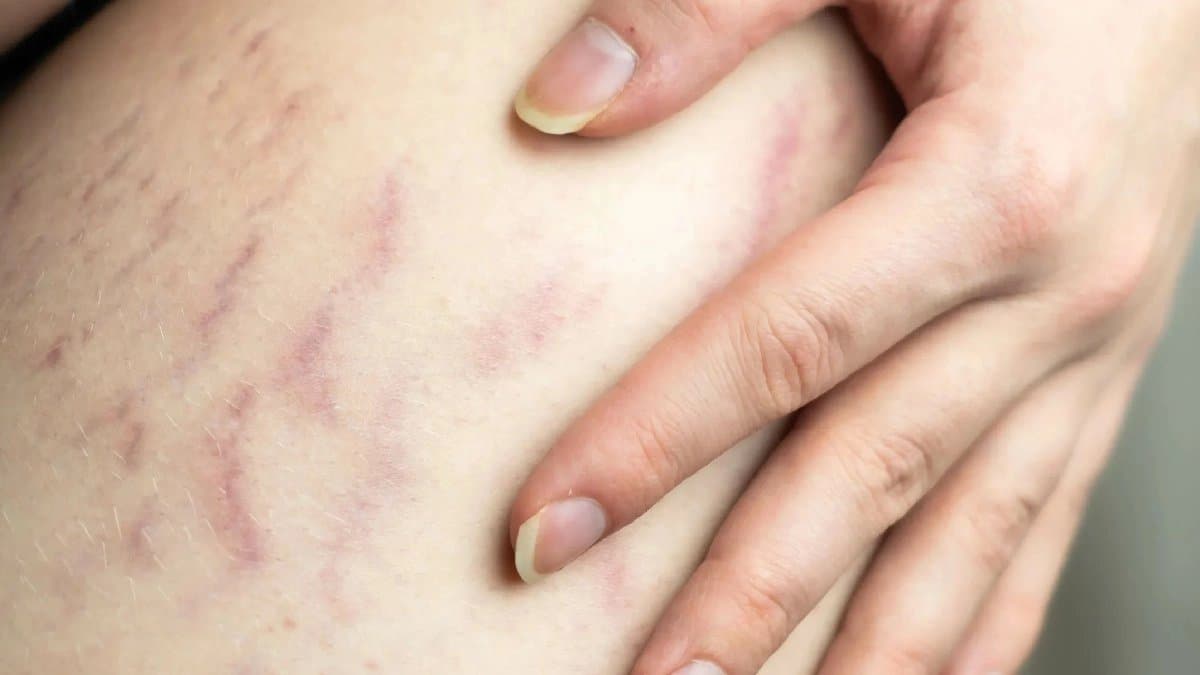 home remedies to get rid of Strech Marks