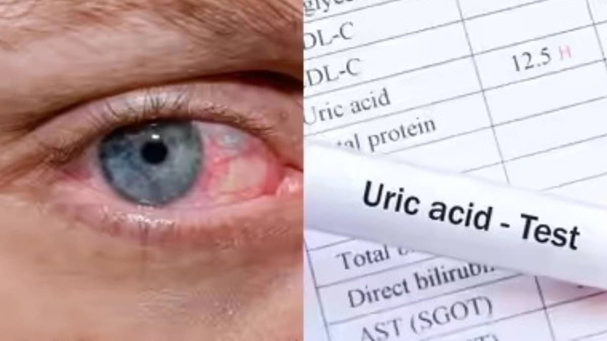 Uric Acid health risk: High uric acid could be dangerous for  eyes 