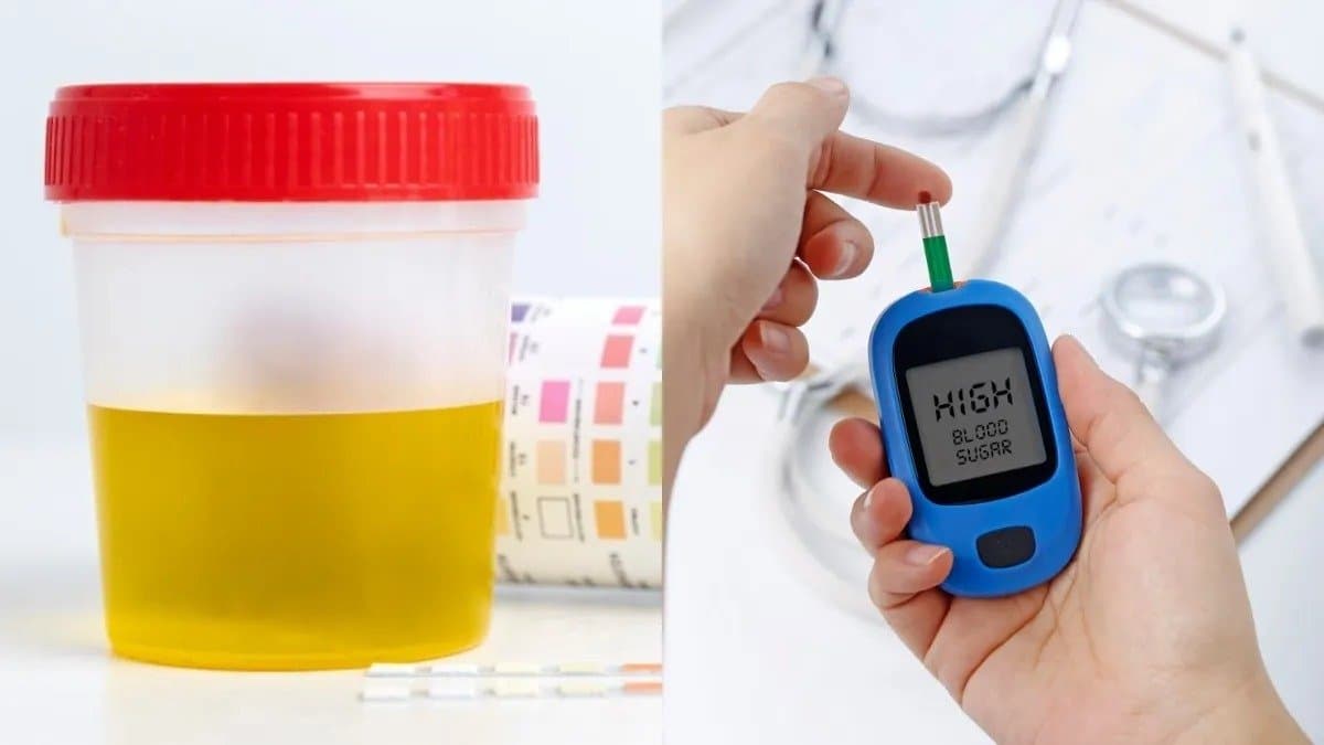 These symptoms of diabetes are seen in urine should not be ignored