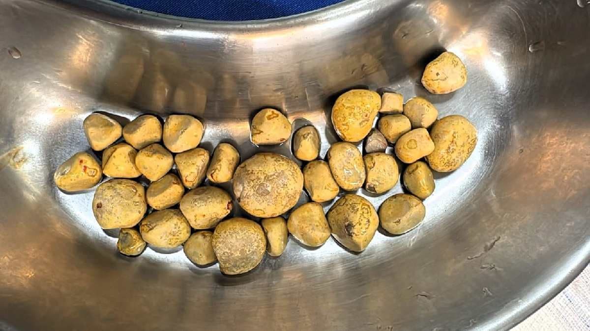 Man who drank cola everyday got massive Bladder stones