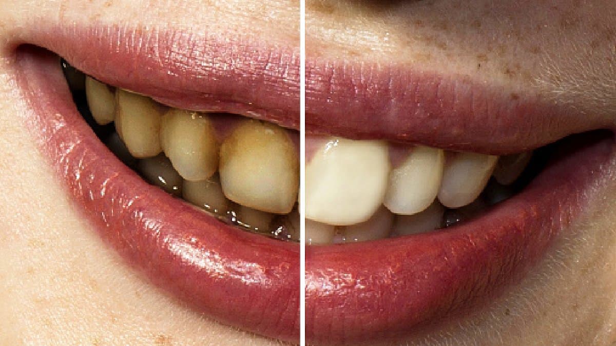 Five home remedies for removal of yellow stains of teeth