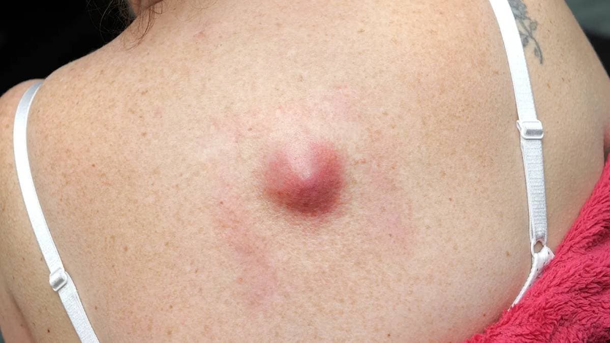 Be allert if lumps appears on your body