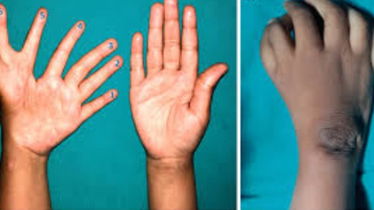 Eight fingers on one hand  rare disease affects a girl child in India