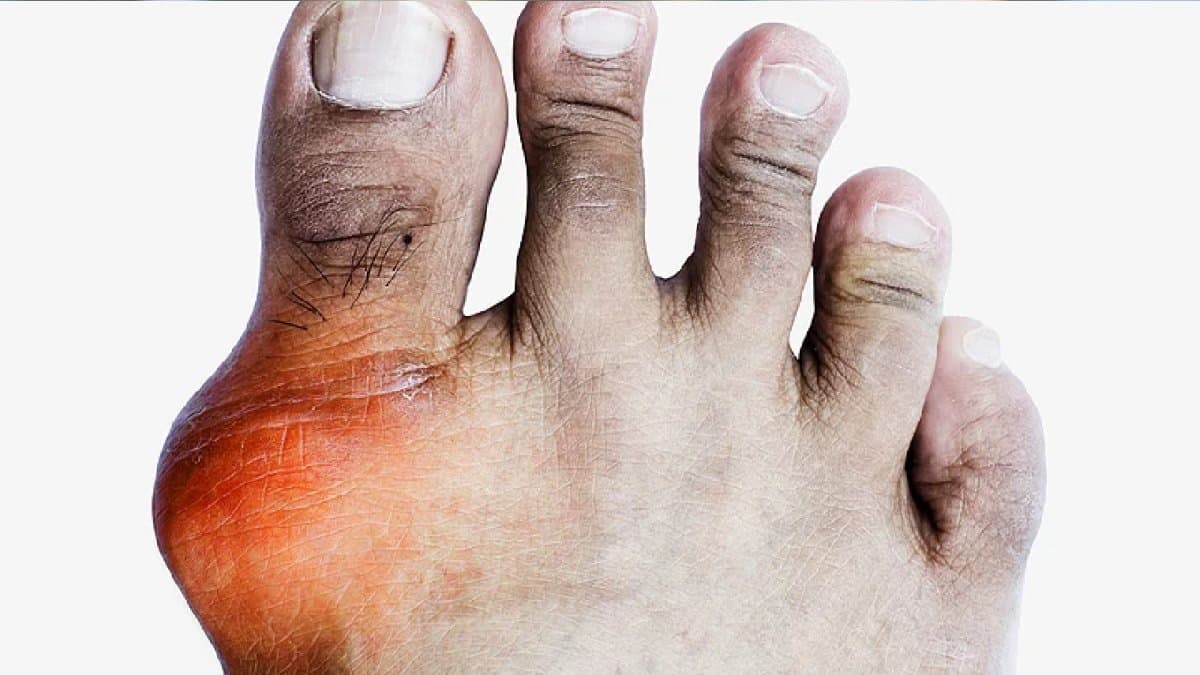 foods you should eat to reduce uric acid lif