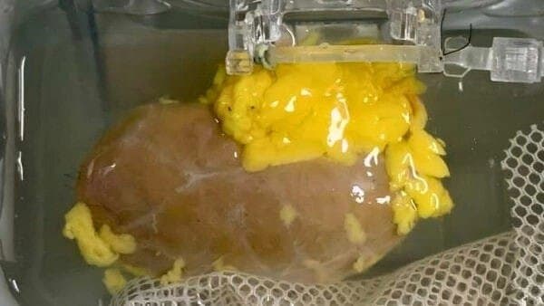 Scientists Create Universal Kidney To Match Any Blood Type 