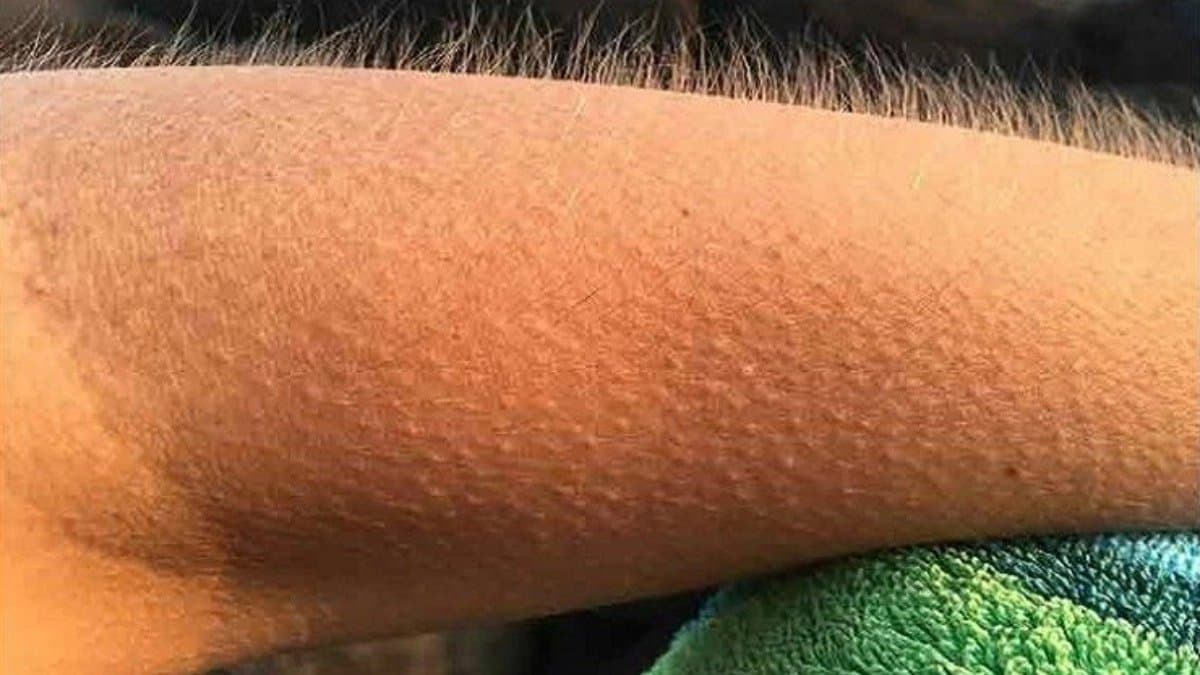 people who get goosebumps while listening to music have a special mental condition
