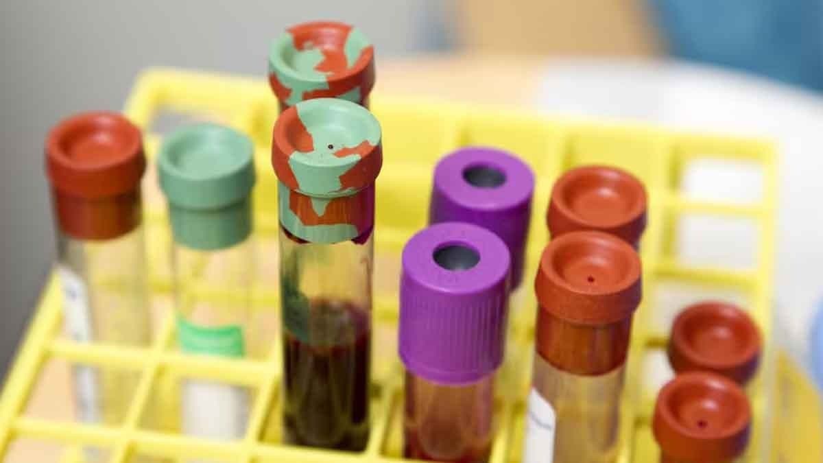 Which blood group affect your stroke risk_gnr