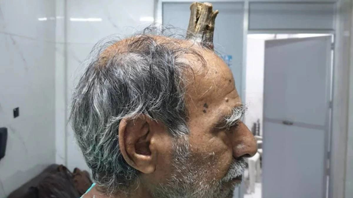 Sebaceous Horn arose on old mans head