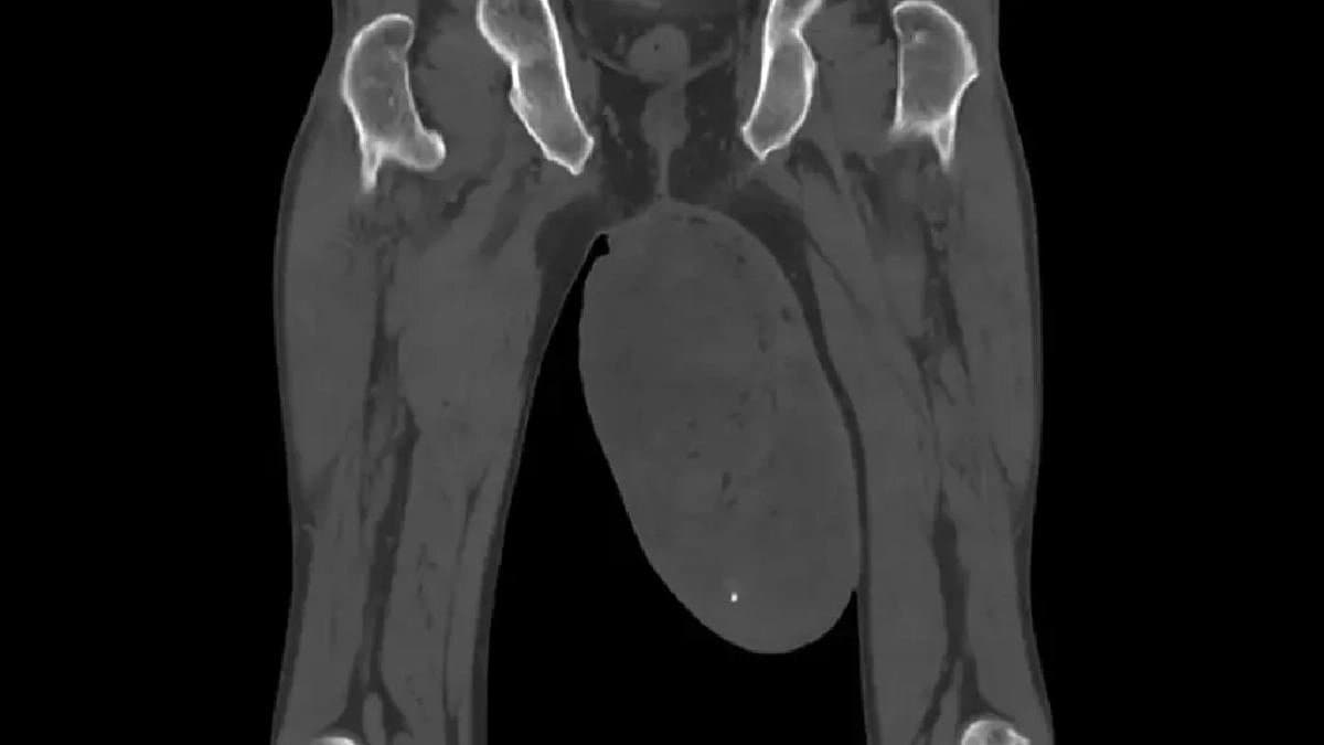 Patient suffering from Rare Medical Condition goes through Urology Operation