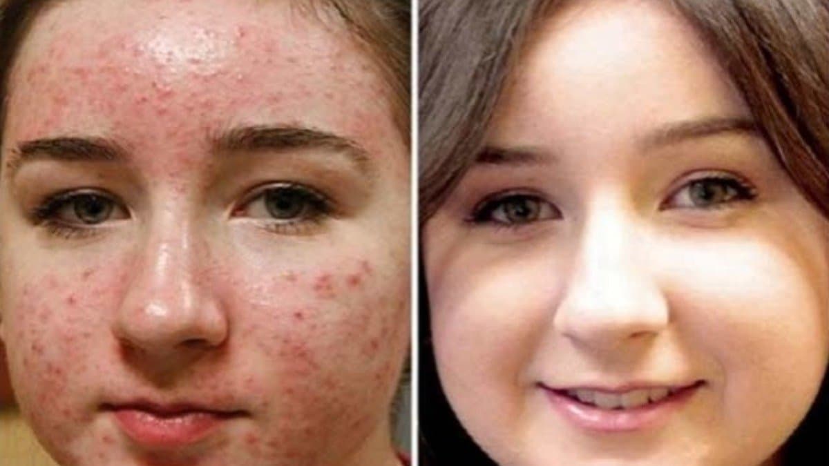 these 5 homemade face packs work like magic to reduce acne problem of face details inside lif