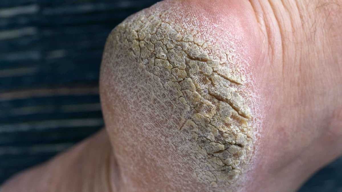 Five Home remedies to heal cracked heels