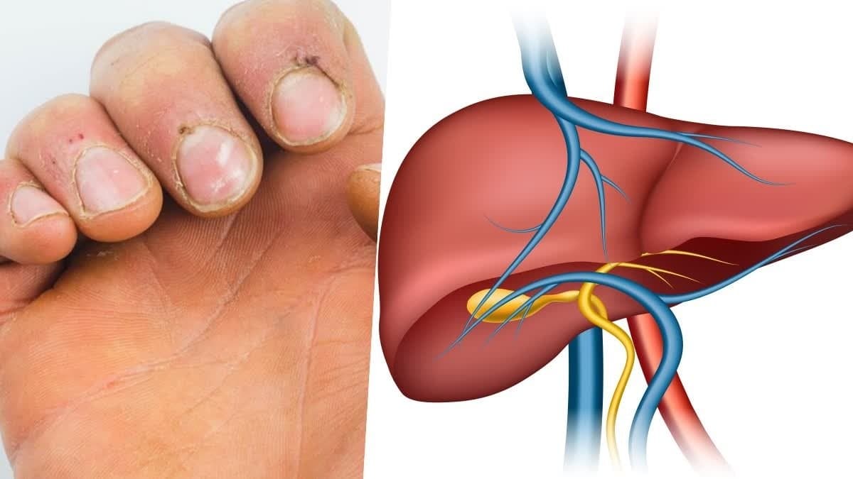 These symptoms of nails can indicate critical liver disease