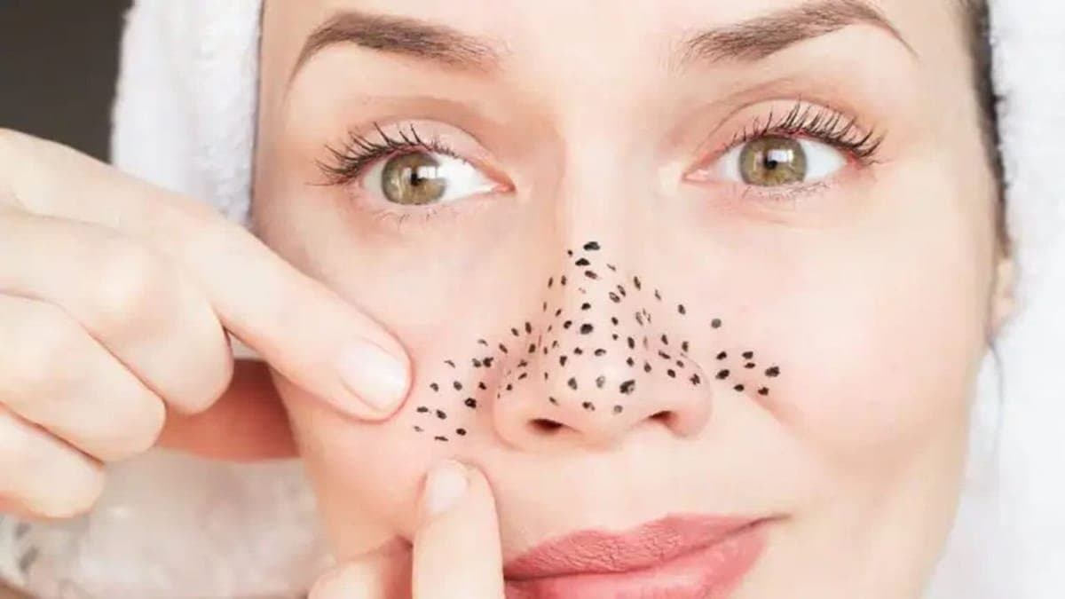 this home made remedy can prevent blackheads on your nose and make them clean soft lif