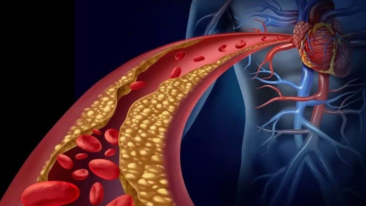 What should be the level of cholesterol in blood to avoid heart attack stroke and What is the normal LDL HDL level according to age lif