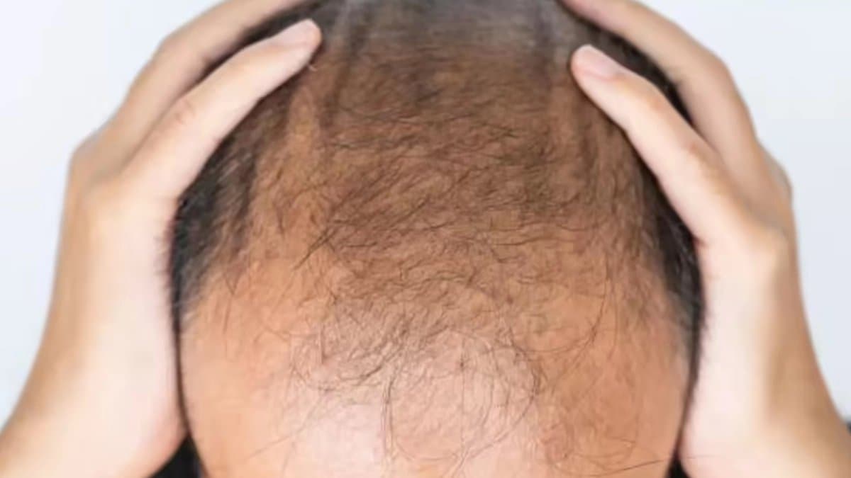 Serum that restores hair in 20 days Scientists big claim