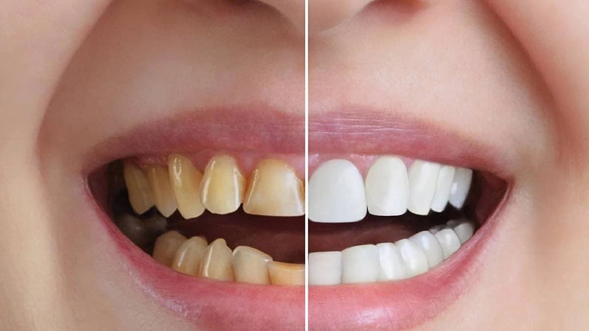 Oral health home remedies to get rid of teeth yellowness