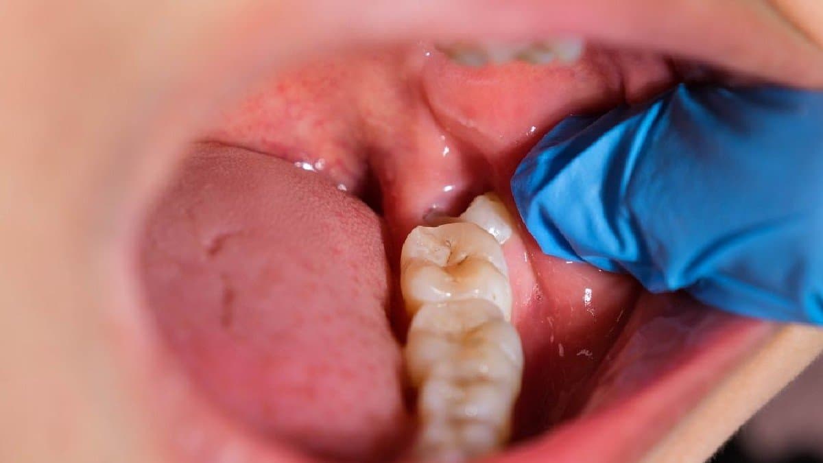 how can mint leaves heal tooth ache lif