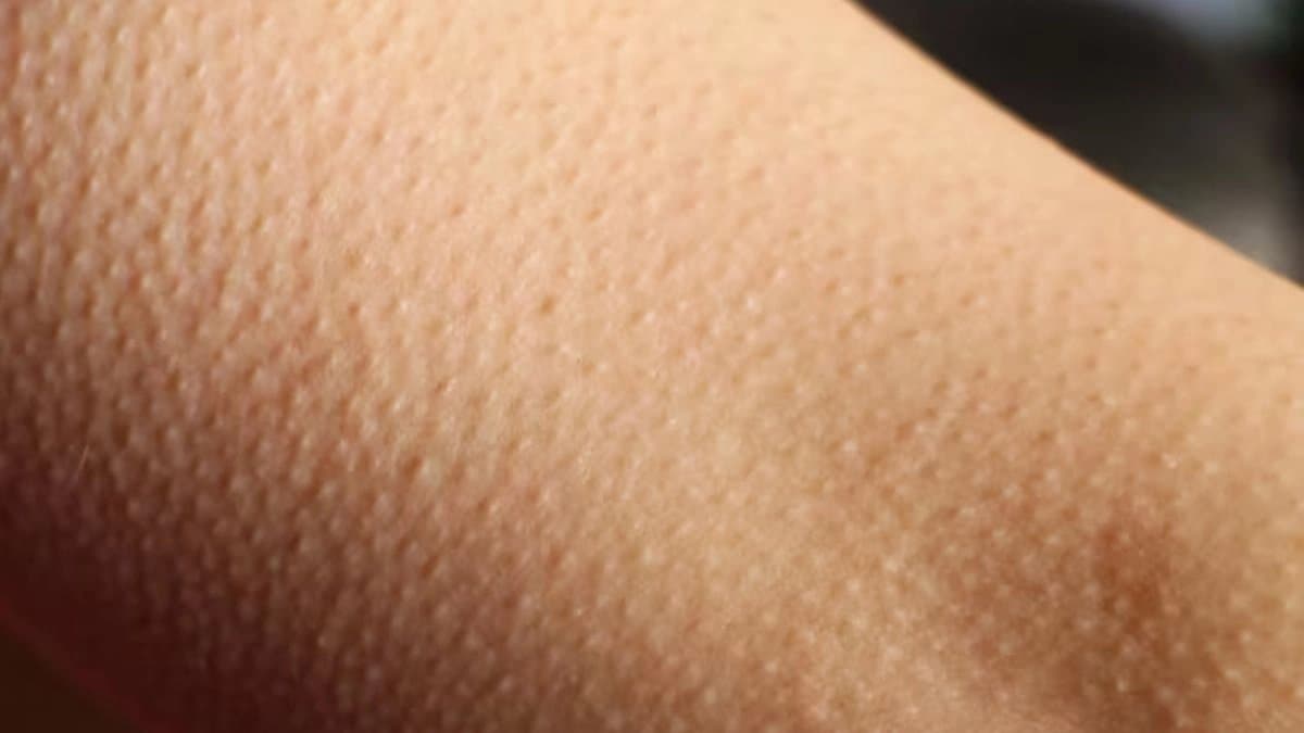 What is goosebumps why do humans get them