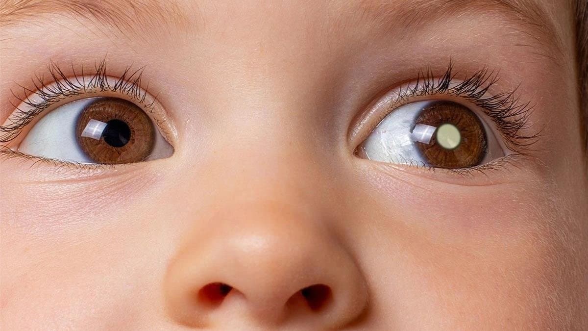 What is Retinoblastoma and what are symptoms and treatment