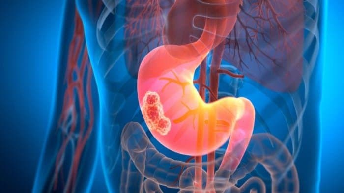 The influenza flu virus is being used to cure pancreatic cancer 