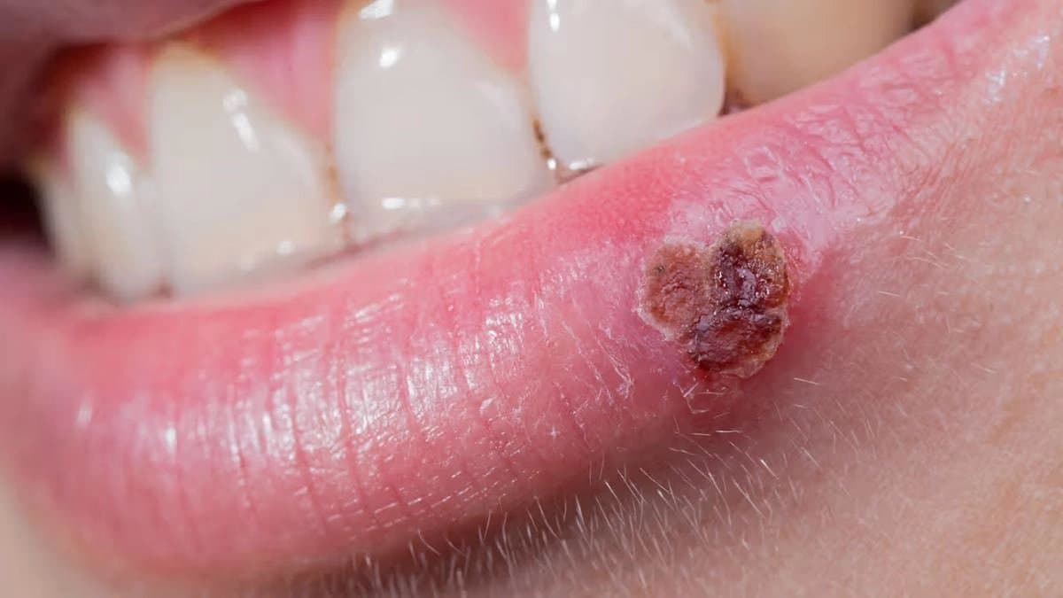 Dangerous Herpes virus can spread through Lipstick or Lip Balm says study