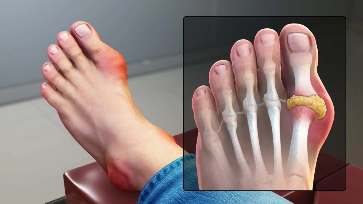 Scientists discovered a 20 million year old gene that can revolutionise Gout Treatment
