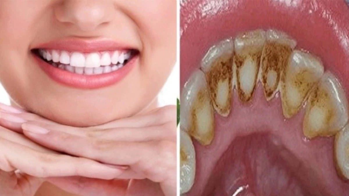 By chewing sesame seeds and spit them out your teeth will clean remove dental plaque