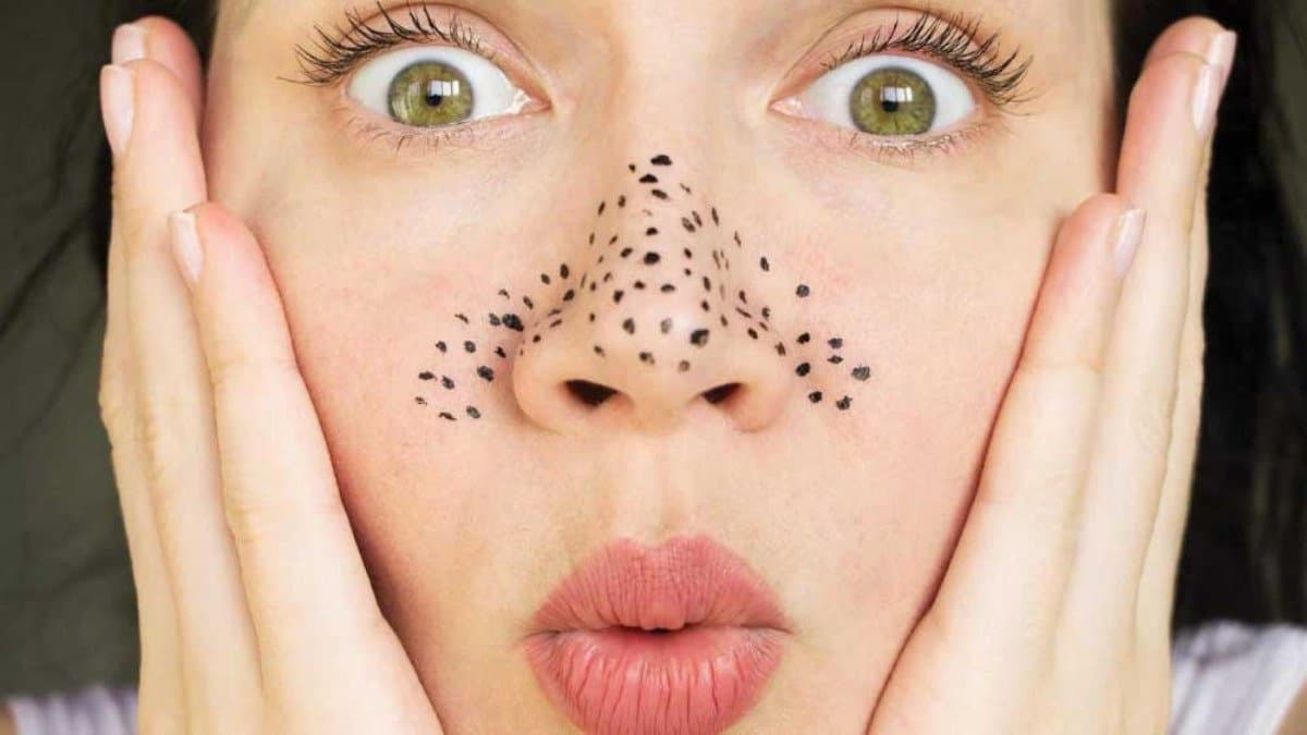 this tip helps to remove blackheads at home details inside