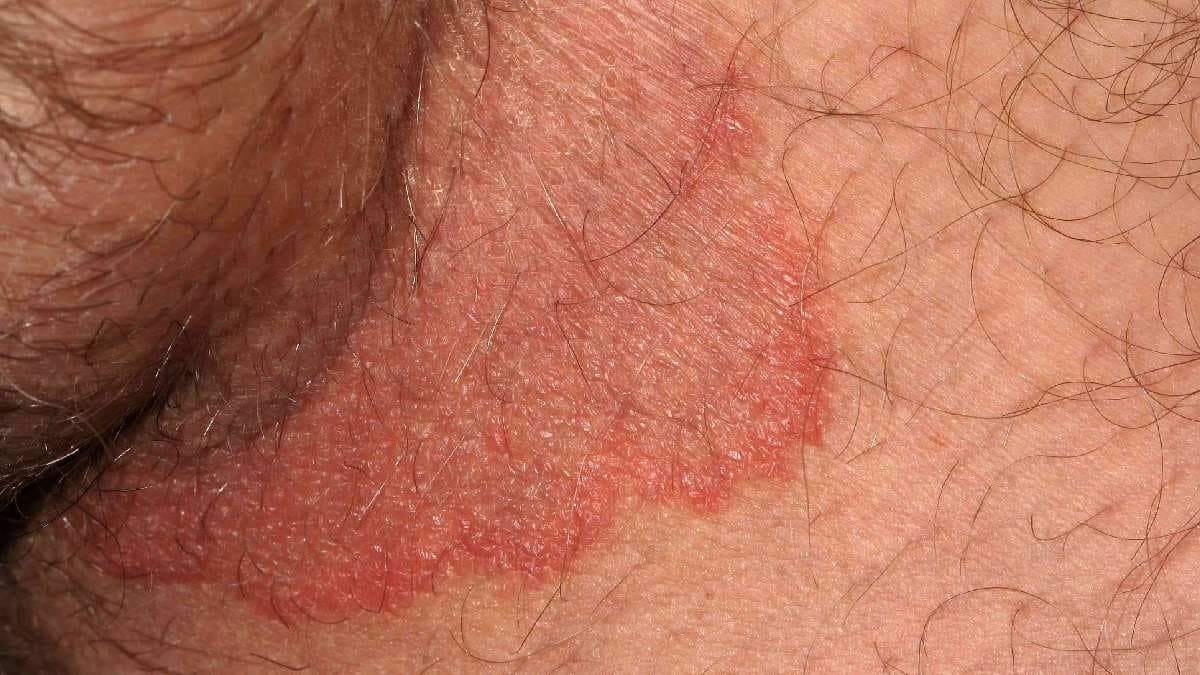 uncommon symptoms of Diabetes