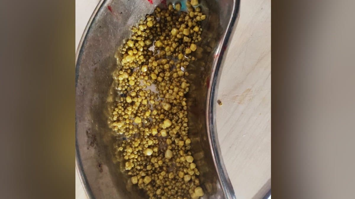  1000 stones removed from stomach following a gallbladder operation