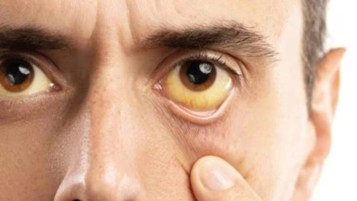  5 Major Causes Of Jaundice You Should not Ignore