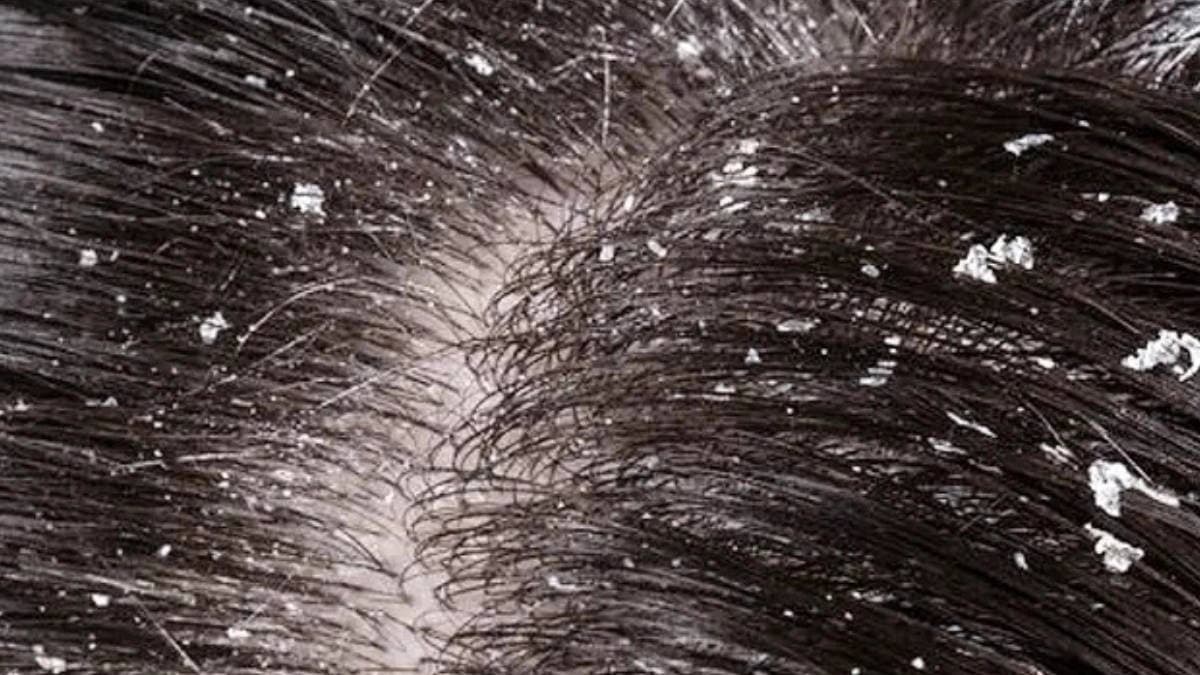 These home remedies help to get rid of dandruff