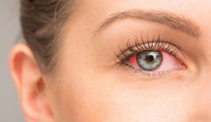 Common eye infections in monsoons and their treatment!