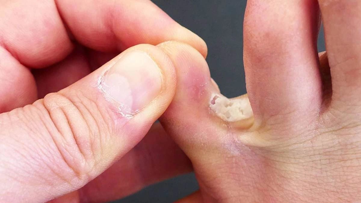 Tinea Pedis Fungal Infection can cause Athletes foot symptoms and cure