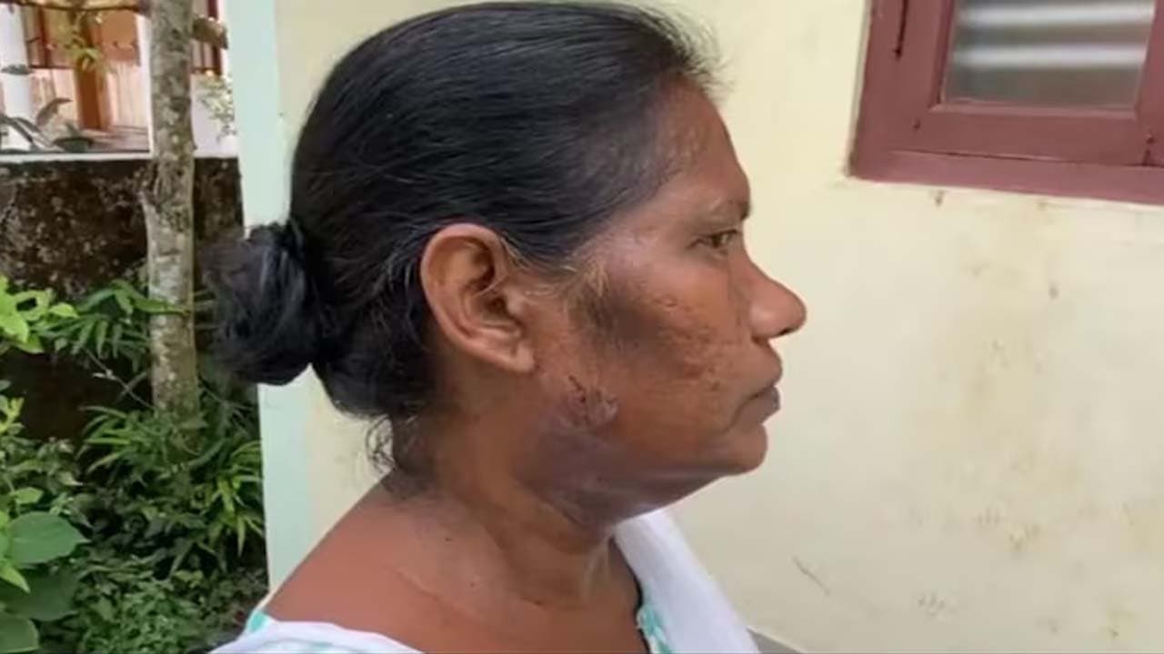 BLO bitten by dog ​​in Kerala during SIR