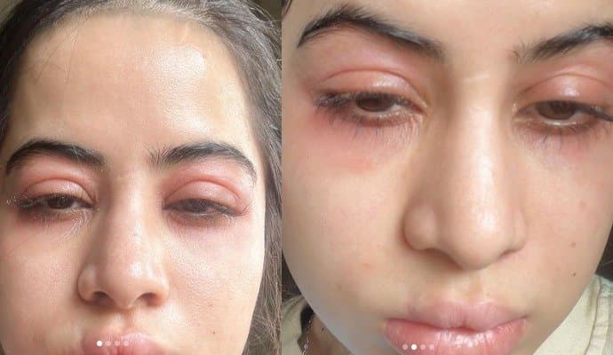 Urfi Javed raises concern about trolling on her swollen face! 