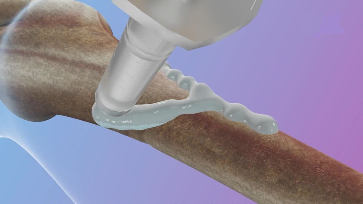 Chinese Scientists Develop Bone Glue that heals fracture in three minutes