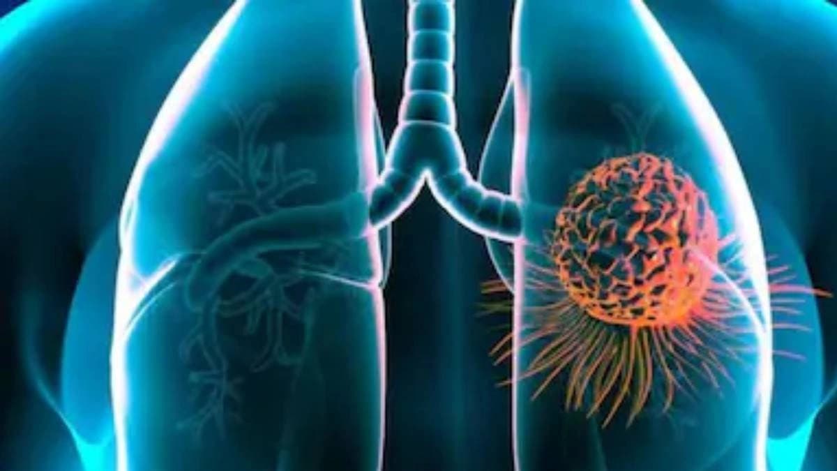 Early Symptoms And Red Flags For Common Cancers In India Know From the Specialist