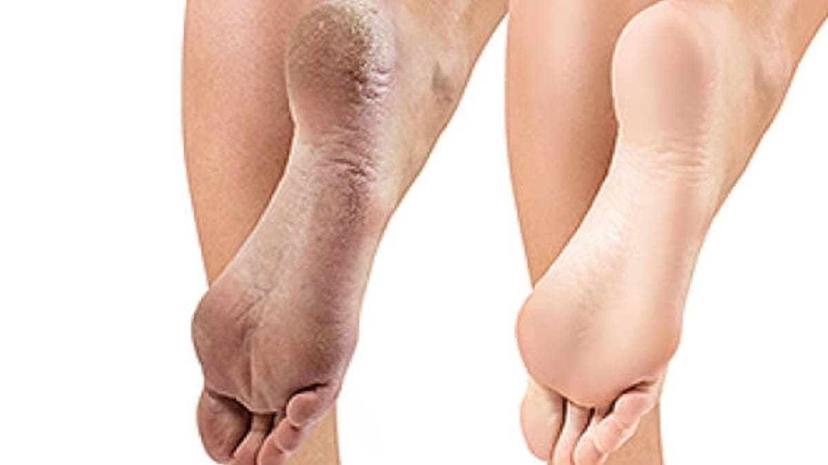 By this trick of toothpaste and others materials you can healed your cracked heels very fast lif