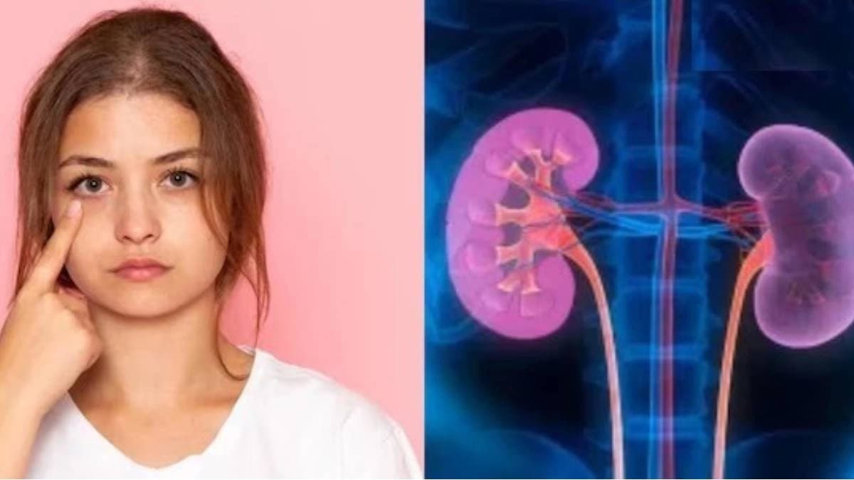 Kidney Disease symptoms: These signs of eyes indicate that your kidneys become seriously ill
