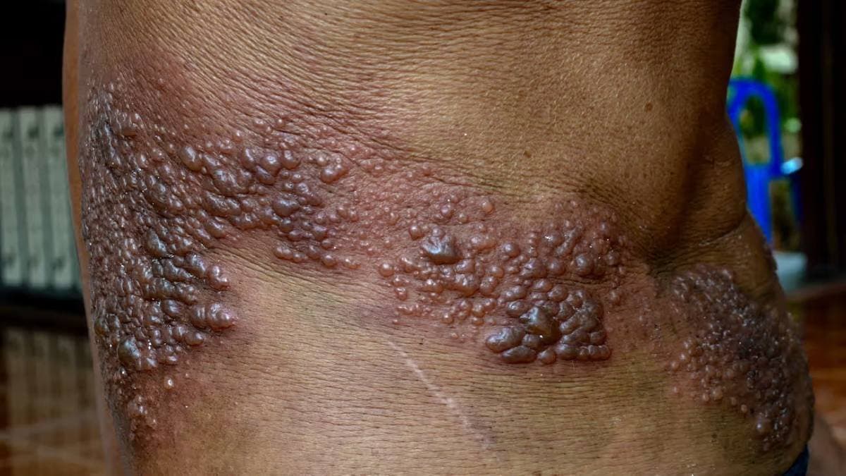 Herpes virus can cause brain disease and spread through oral intimacy
