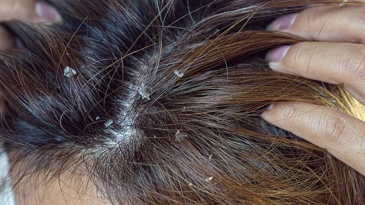 These home remedies help to get rid of dandruff 