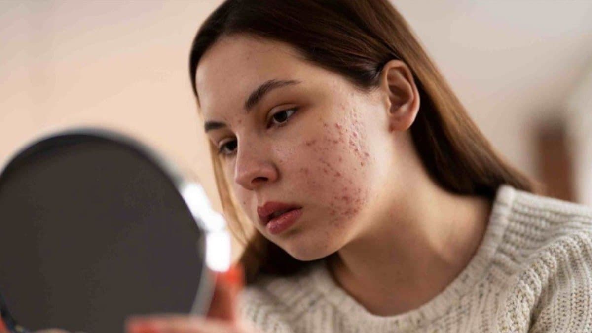 These homemade face pack help to remove acne spot quickly