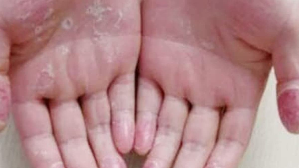 Exfoliativa is a skin problem where old skin tone removed through the year lif